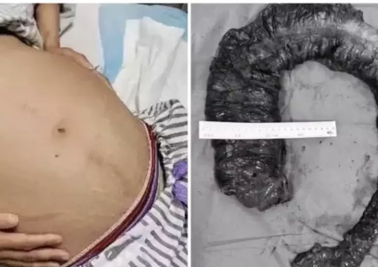 Chocante: Após passar 10 dias sem fazer cocô, médicos tiram 20KG de fezes do intestino da mulher: ‘Corpo est… Ver mais